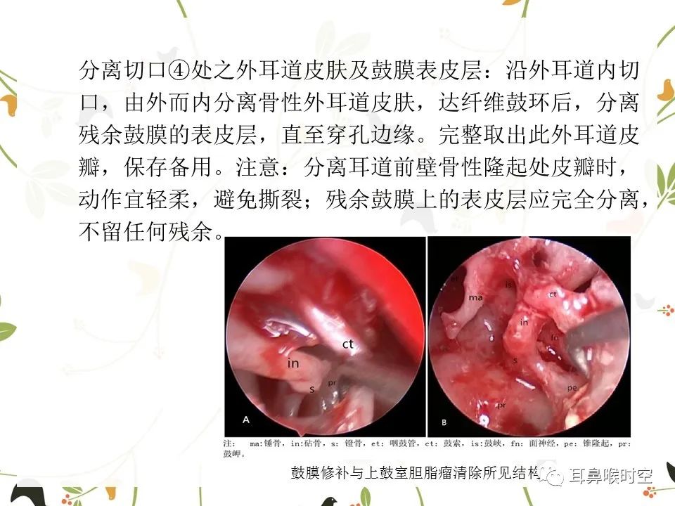 鼓膜可见穿孔,鼓膜穿孔听力下降能恢复吗