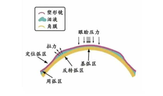 ok镜的优缺点及适应症,ok镜延缓近视的原理