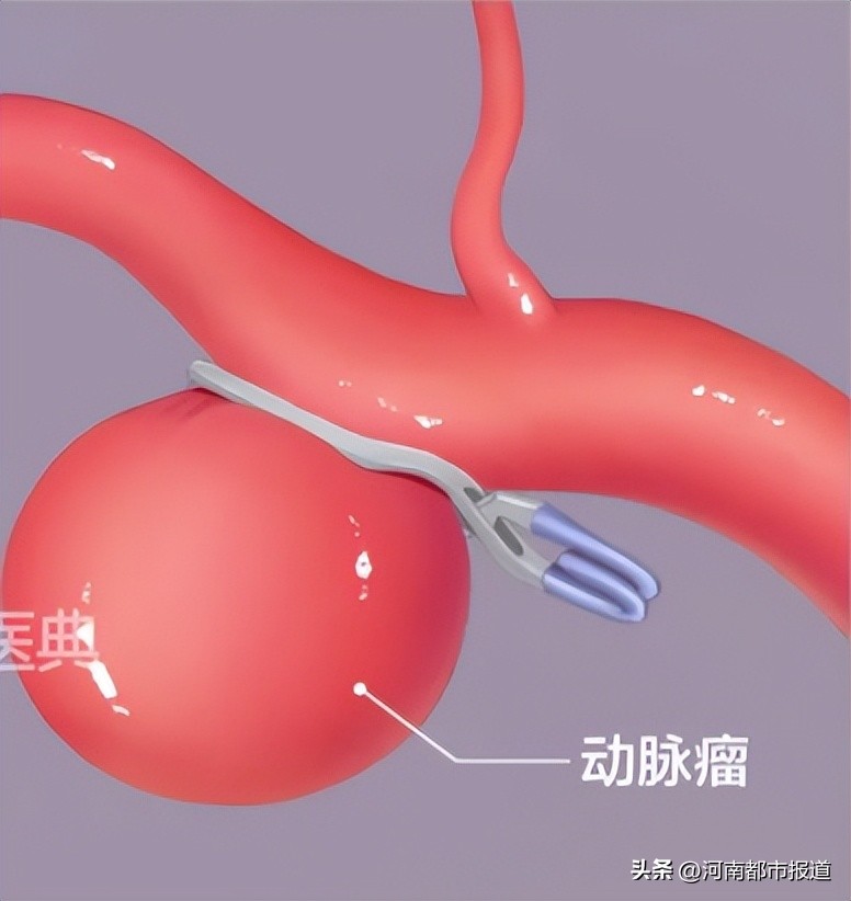 宝宝坠床摔出“动脉瘤”，回老家河南千里寻医