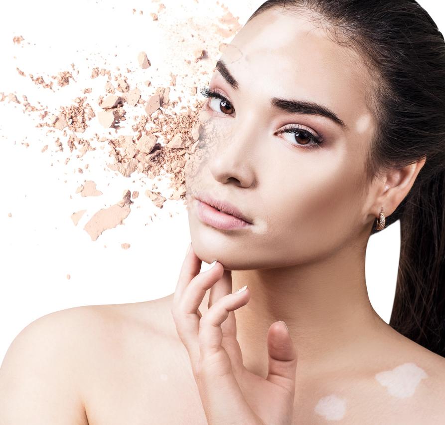 稳定期的白斑怎样快速复色,一般照几次白斑可以复色