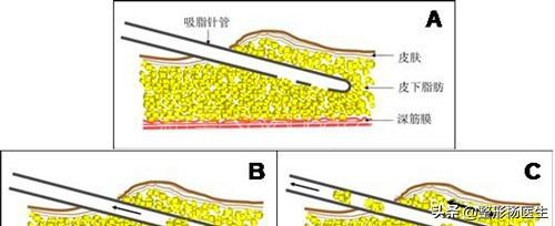 怎么预防大腿吸脂凹凸,大腿吸脂如何避免脂肪栓塞