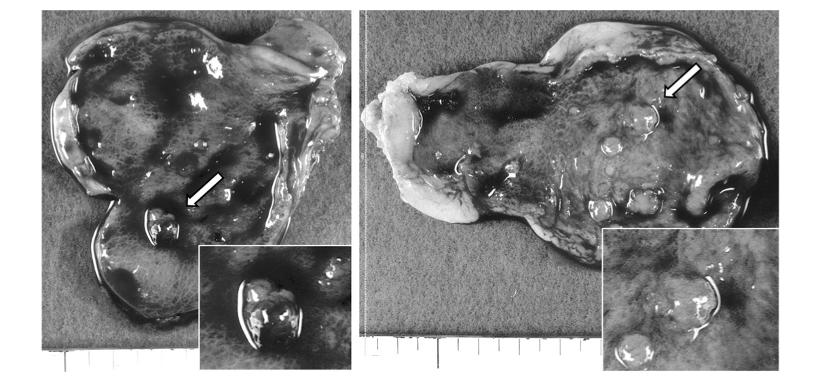 胆囊多发息肉样病变8mm*6mm,胆囊息肉病变0.6严重吗能喝酒吗