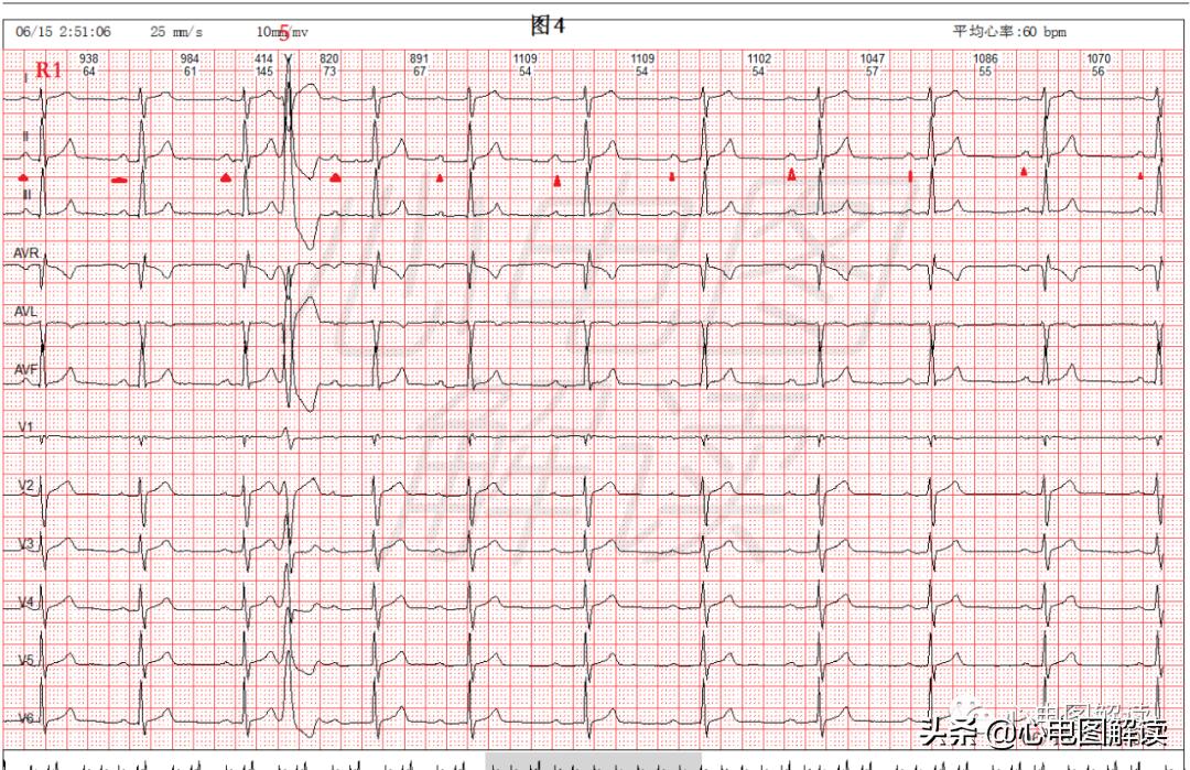 插入型室性早搏严重吗,插入性室性早搏心电图