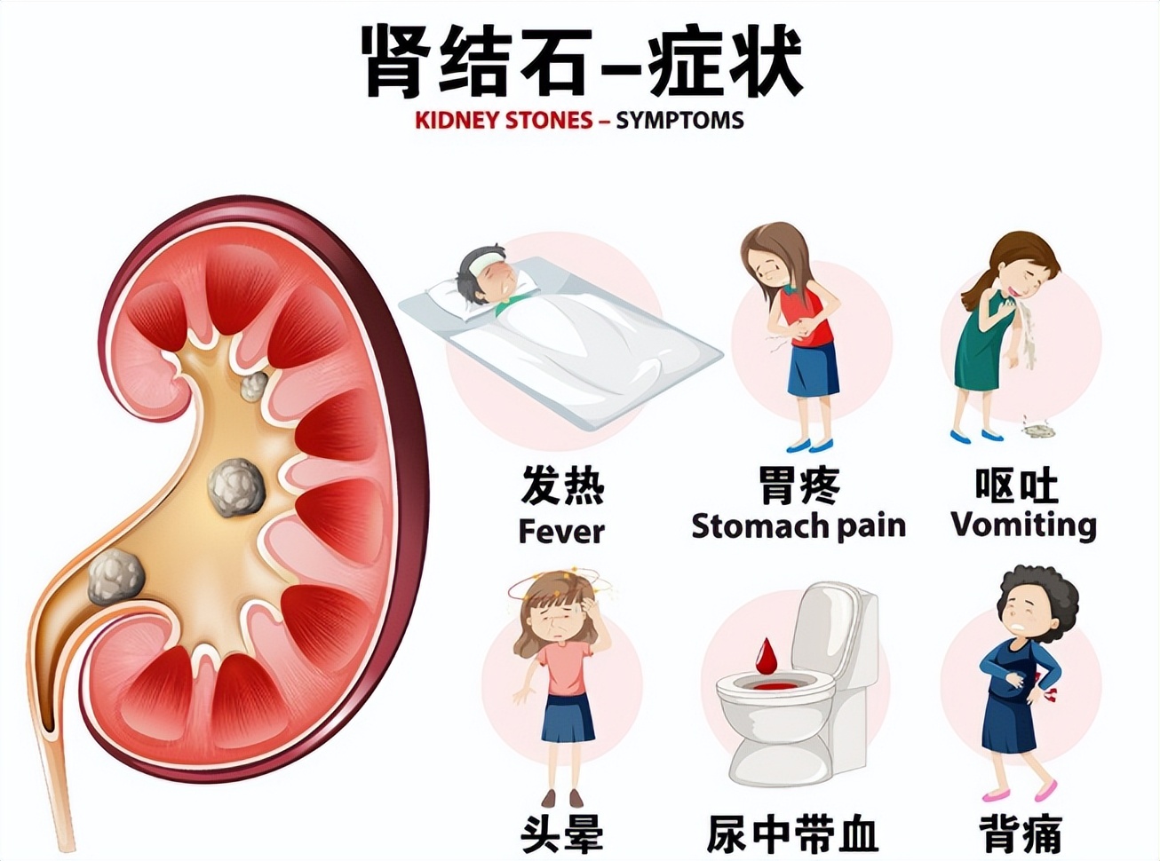 肾结石是不是经常发作,肾结石有石头不痛要治吗