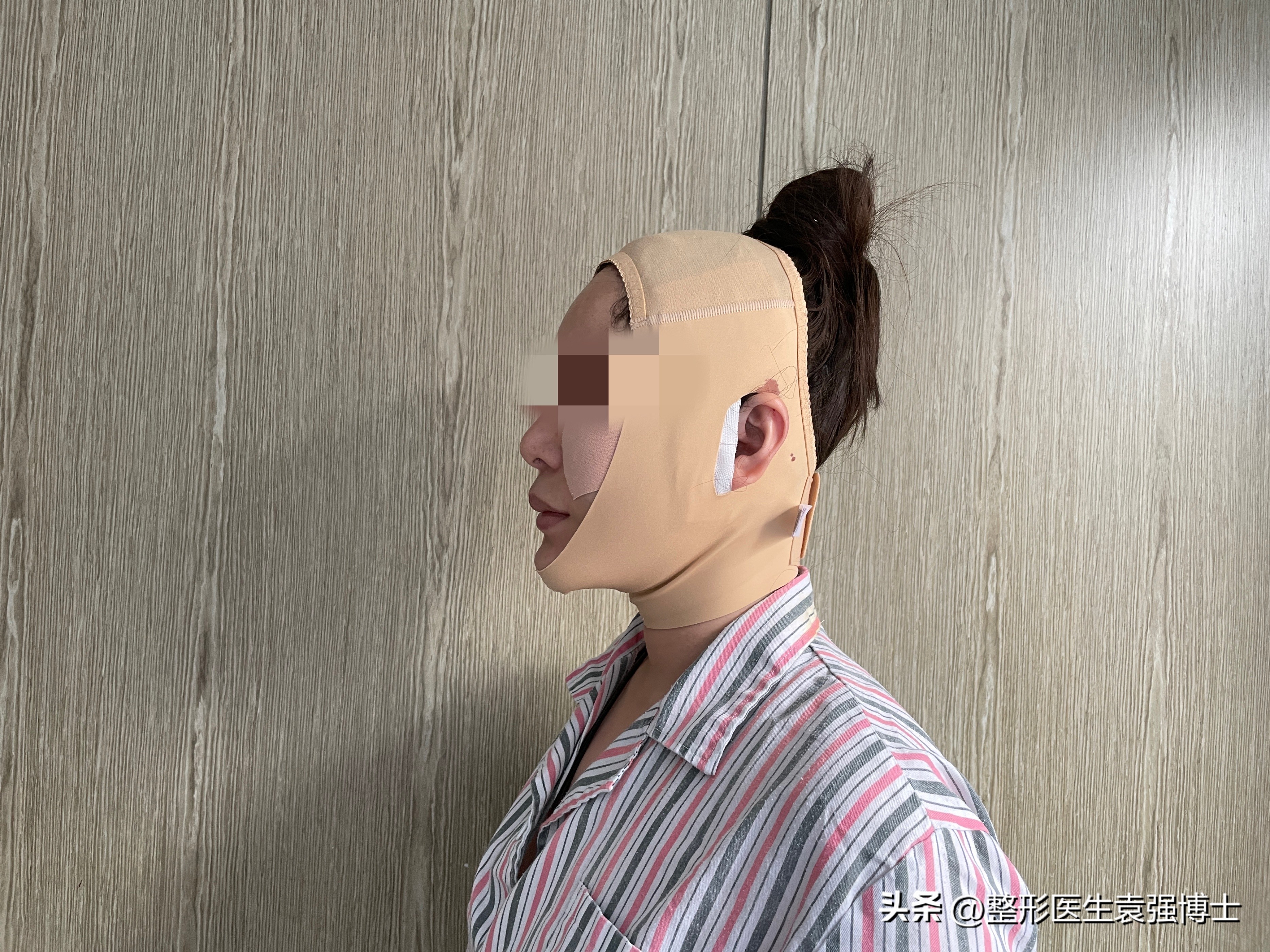 拉皮手术后的真实面部对比,拉皮手术真的会让人看起来年轻吗