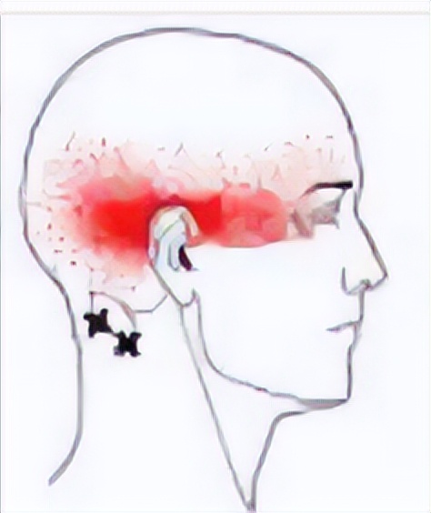 颈复康治疗颈源性头痛吗,颈源性头痛整体解决方案