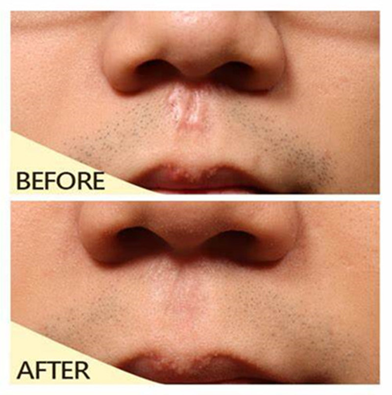 像个“小肉球”似的增生疤痕，是不是无药可救了？医生这样说：