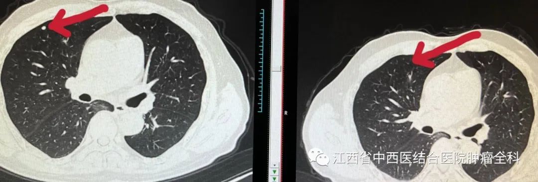 肝癌多发性肝内转移靶向药,肝癌中晚期免疫靶向有奇迹出现吗