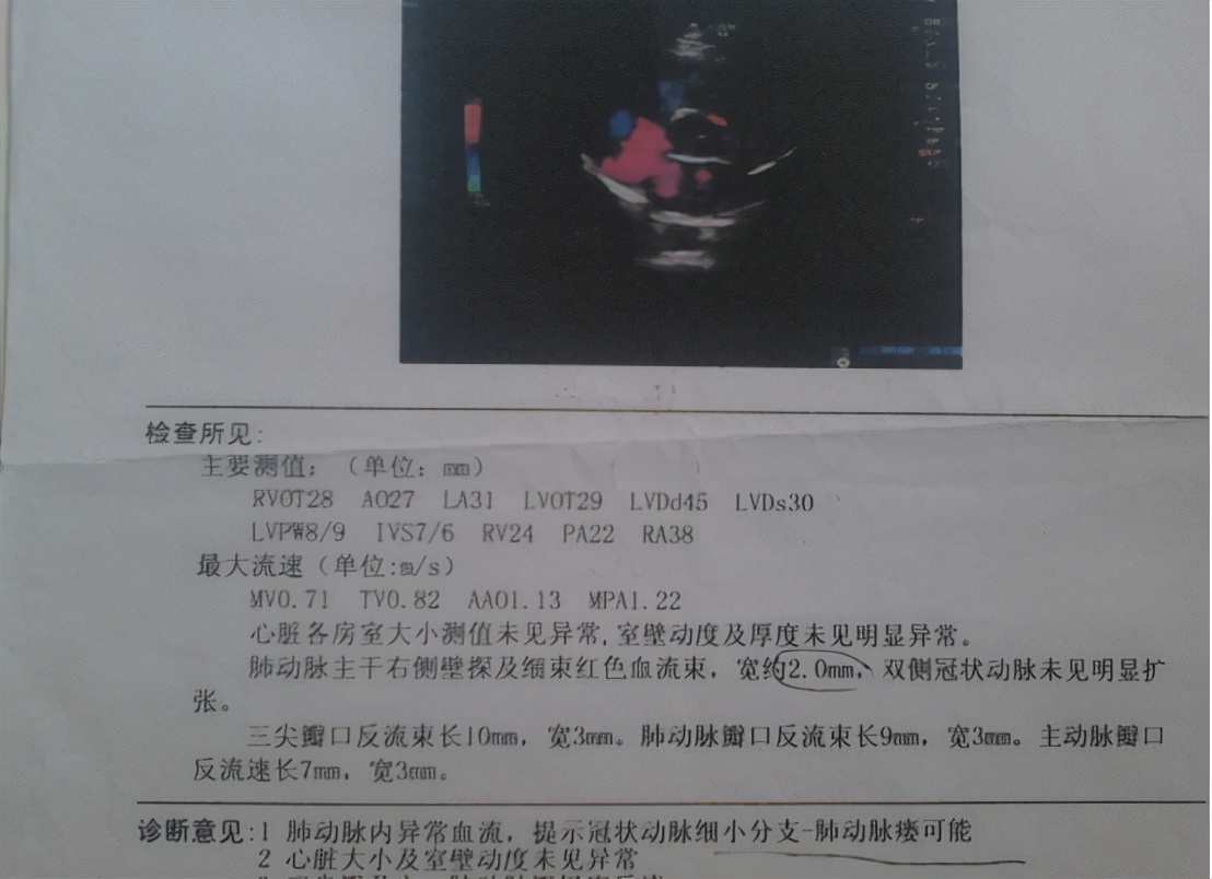 国产降压新药阿利沙坦酯,降压药阿利沙坦酯片的副作用