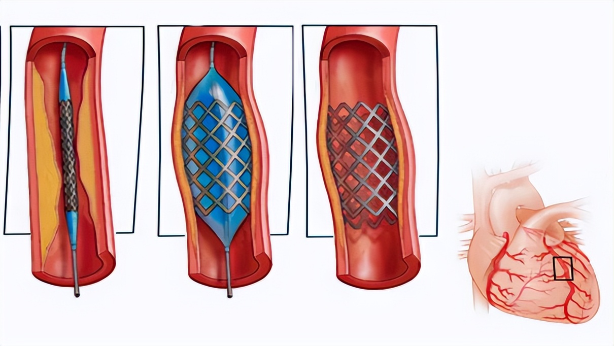 耳垂上有折痕代表有心脏病,耳垂上有折痕代表心血管是谣言吗