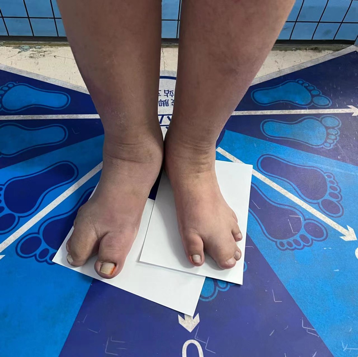 14岁女孩非经期出血,14岁女孩非月经期出血是怎么回事