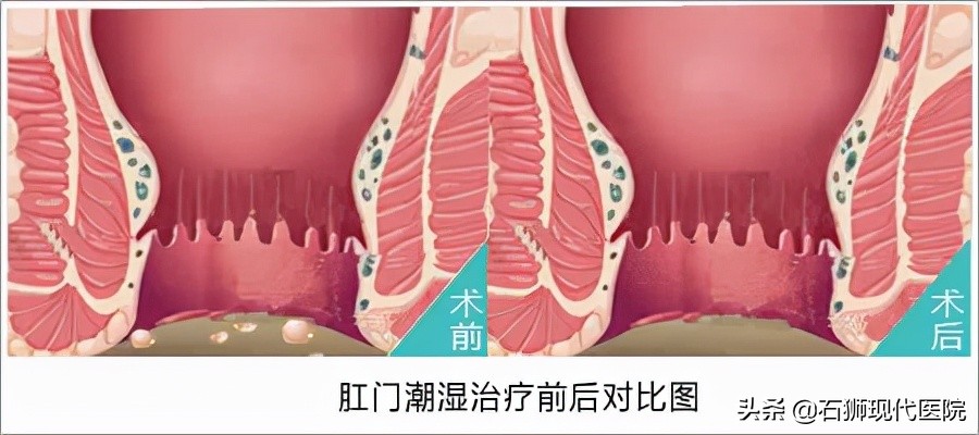 肛周湿疹瘙痒怎么治彻底,肛周湿疹痒得特别厉害怎么办