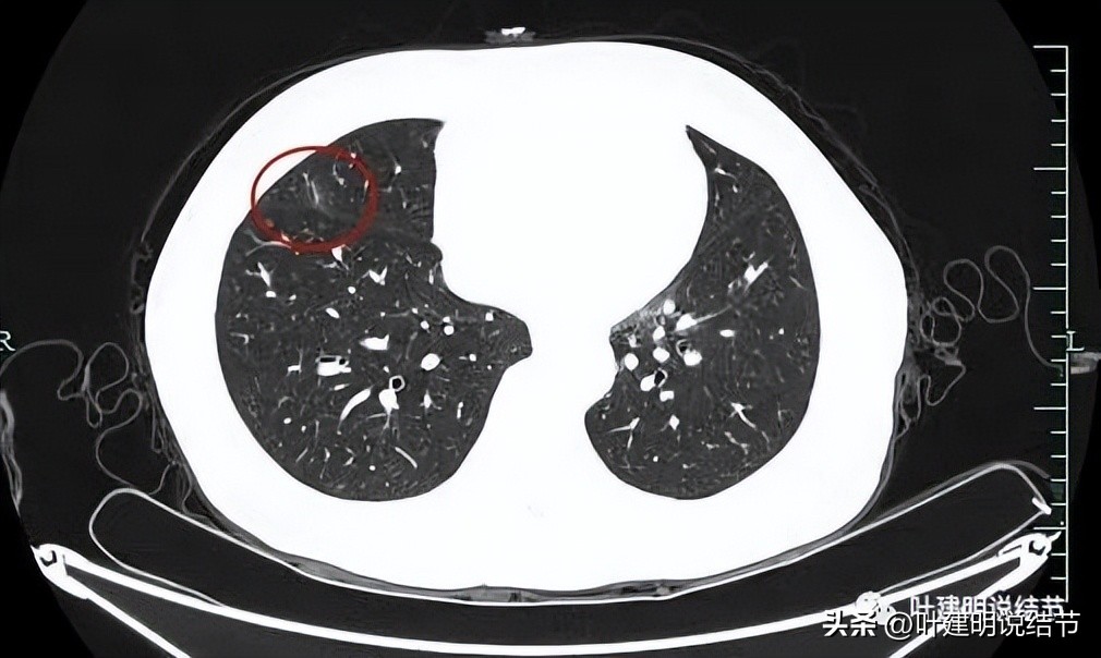辽宁省肺结节手术哪家医院好,辽宁肺结节手术医院