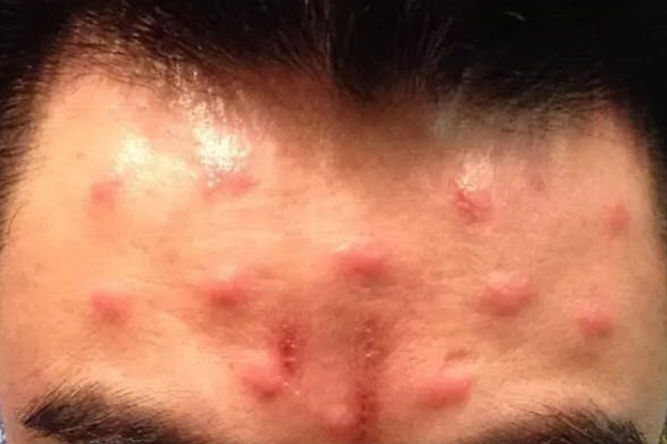 注射完后针眼溃烂怎么办,注射后针孔发炎怎么处理