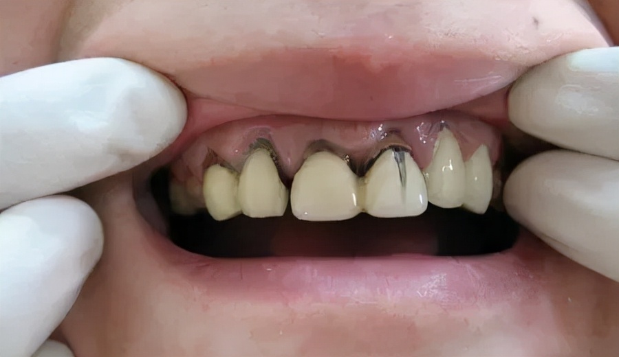 为什么牙医不提倡拔牙而是做牙冠,为什么牙医不想给病人做单冠