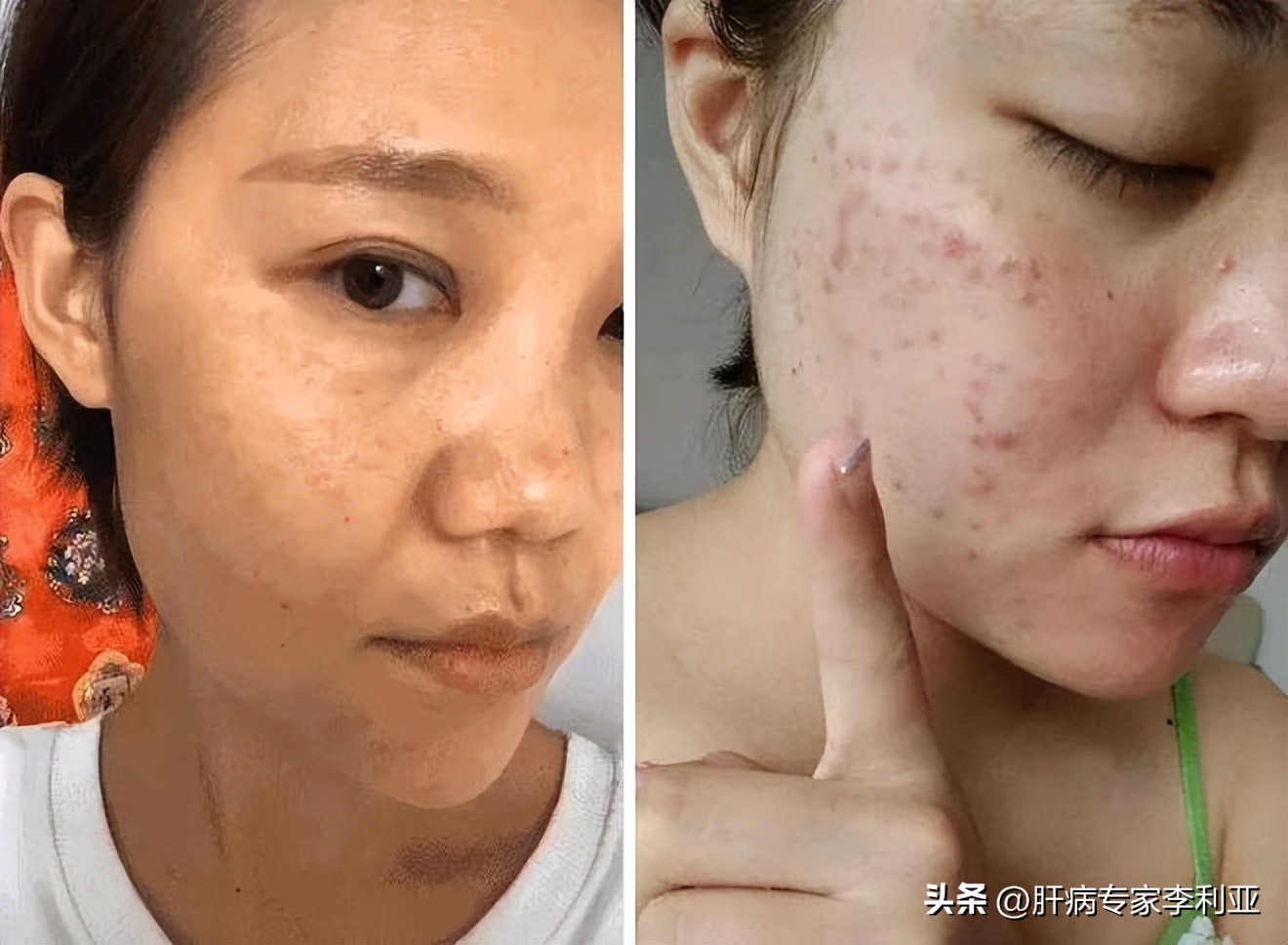 肝癌征兆身上长痘吗,肝癌脸上长痘痘怎么回事