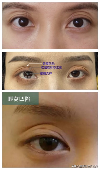 上眼窝凹陷下眼窝水肿怎么回事,眼窝凹陷眼周脂肪填充眼窝可以吗