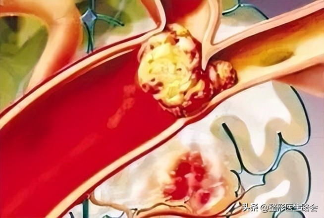 注射填充危险吗,注射栓塞后的处理