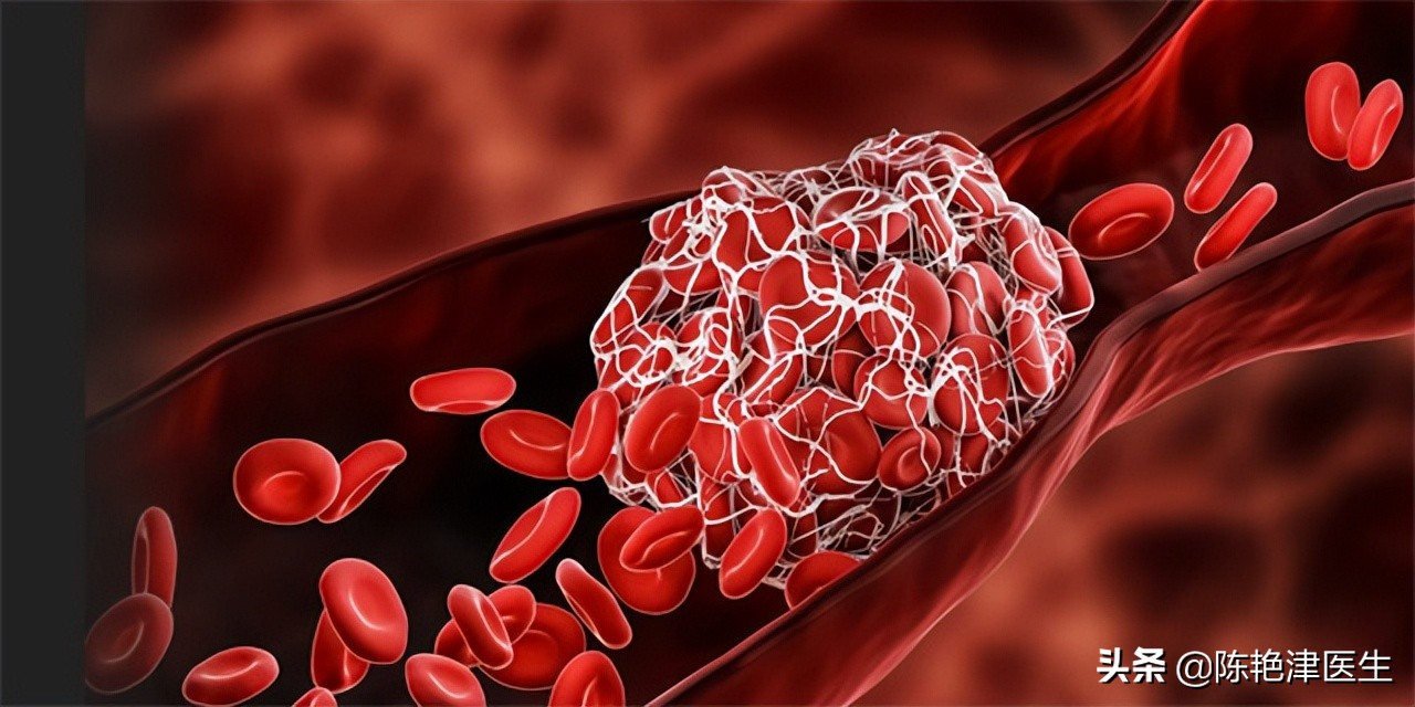 突发脑梗的五个信号,脑血栓脑袋滋滋的声音