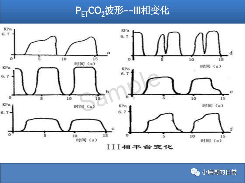 呼气末二氧化碳检测图的解读,呼气末二氧化碳检测操作视频