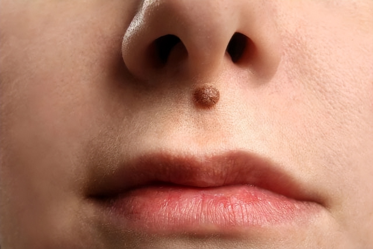 痣可以随便取吗,脸上的痣能随便取吗