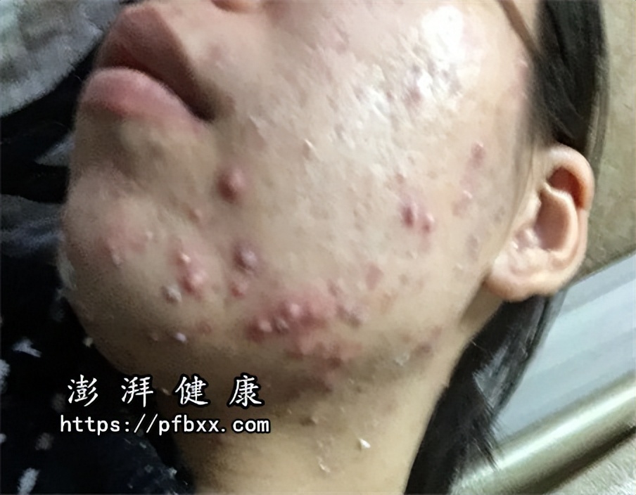 脸上长了硬硬的小鼓包流血,脸上长硬硬的小鼓包挤出血