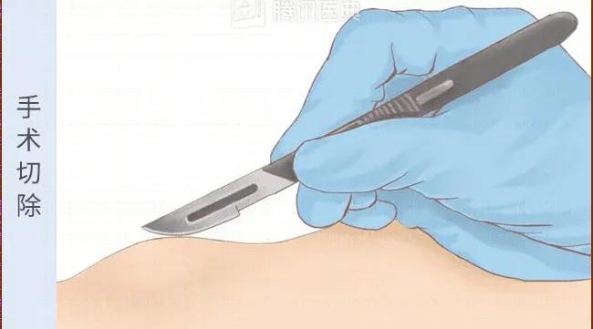 手背上长了个小凸起的包不痛不痒,手背突然起了个包