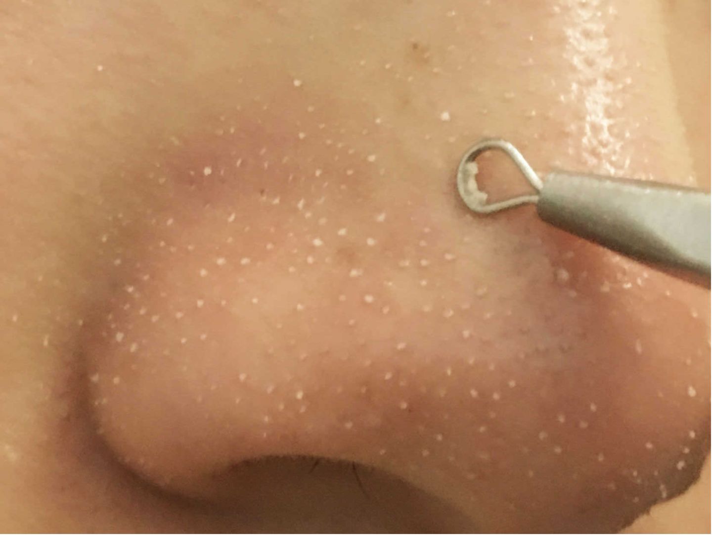 卸粉底后感觉鼻子上的毛孔有白点,为什么上完粉底液鼻子上有黑点