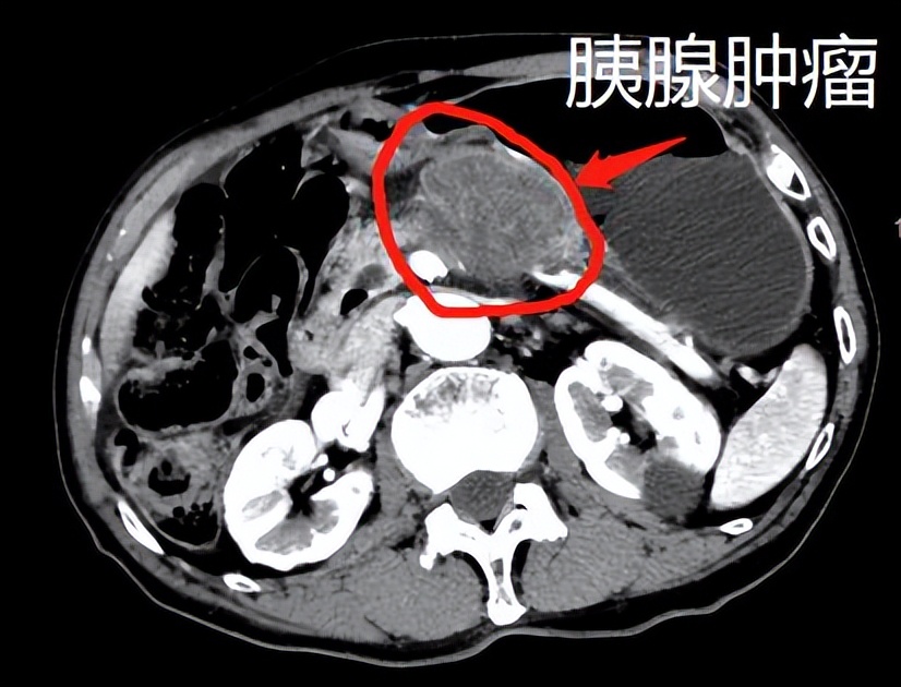 91岁高龄胰腺癌患者，顺利完成胰腺穿刺和治疗