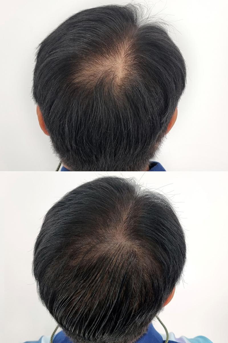 米诺治脱发效果怎么样 (米诺为什么能治疗脱发)