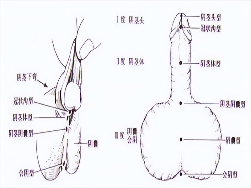 尿道下裂的宝宝尿道正常吗,怎么判断男童尿道下裂
