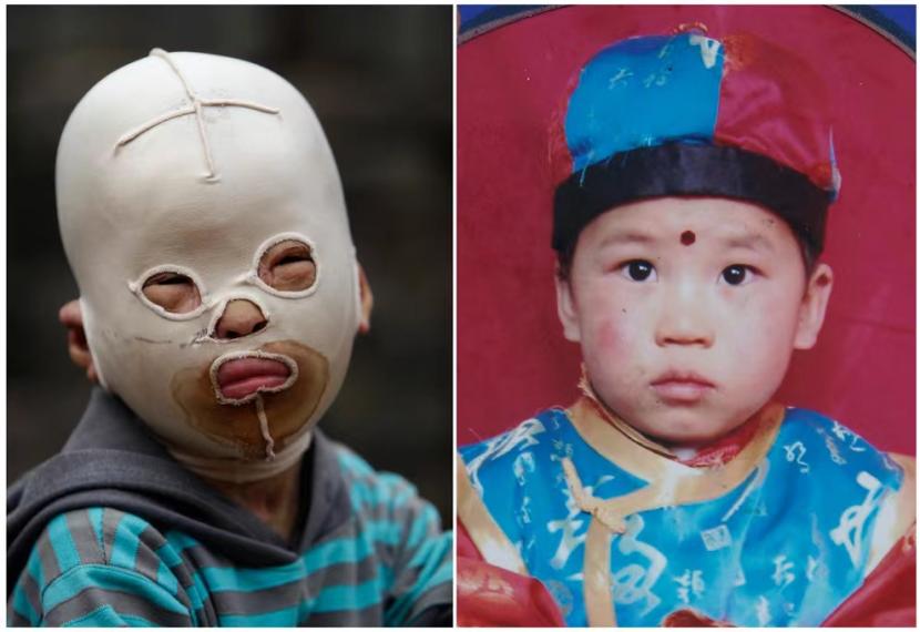 小孩子脸被火烧伤戴着面具,因烧伤带面具的山西小男孩