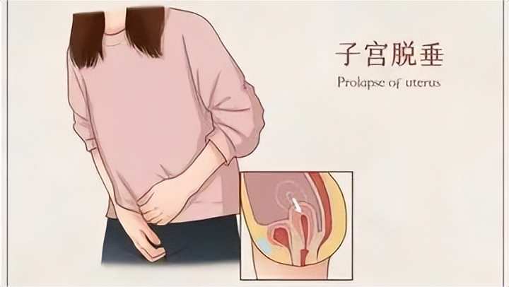 68岁老太，子宫从下面“掉”了出来？如何预防和应对子宫脱垂？