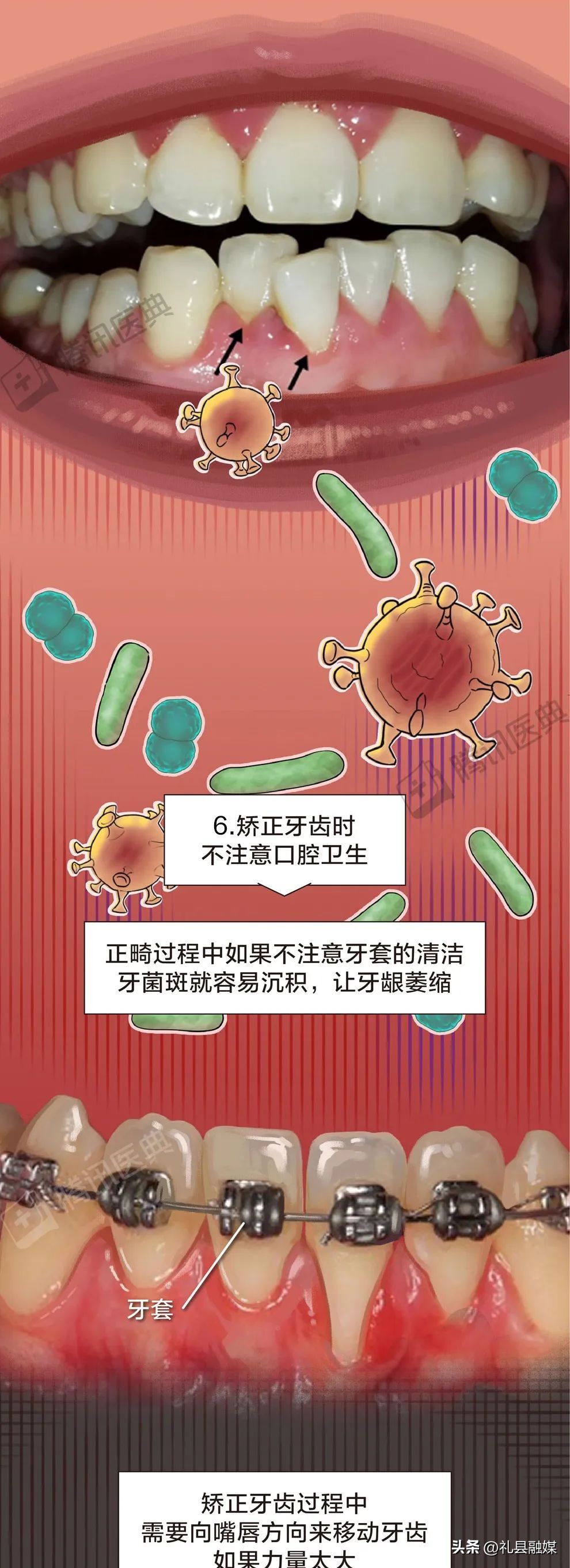 牙缝隙大吃菜就塞牙怎么修复,牙齿吃菜老塞牙怎么办