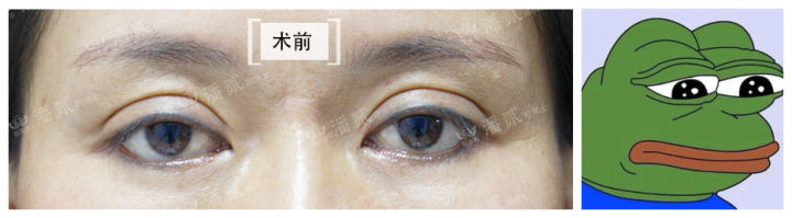 凸眼球显得眼睛大,凸眼眼窝凹陷