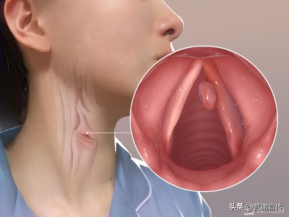 发现息肉，离癌有多远？