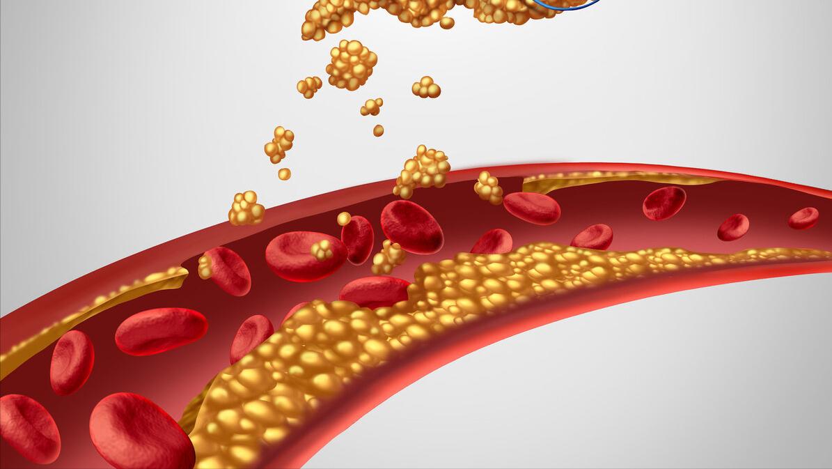 吃生大蒜抗癌真实性如何,生吃大蒜可以抗肿瘤吗