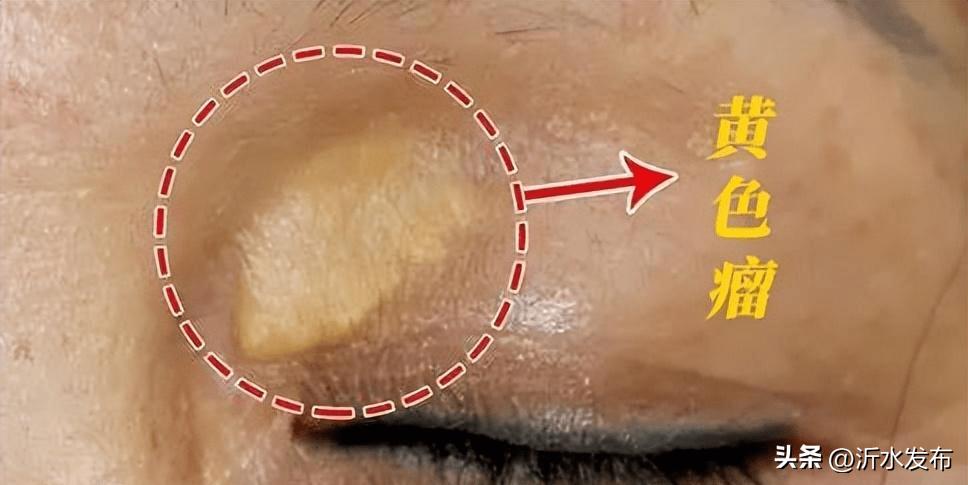 眼周长小小的疣,眼周长小丘疹是怎么回事
