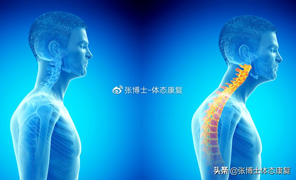 「体态康复」缓解下背痛的十六条建议