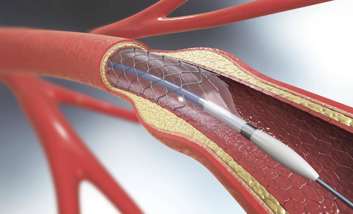 心脏支架手术一般能活多少年,做了心脏支架正常情况能活多少年