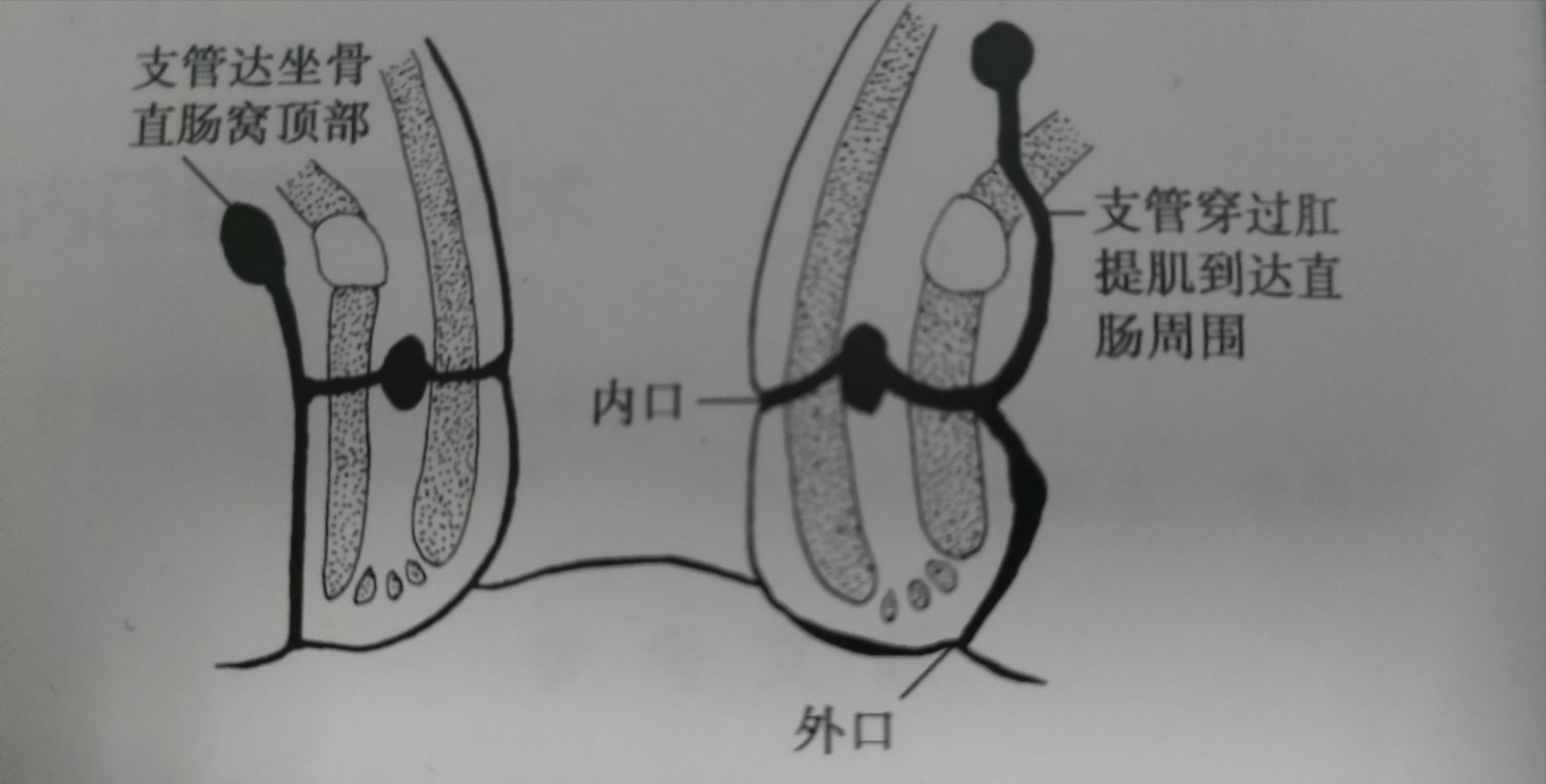 同样是肛瘘,为什么别人术后2天就出院,而我术后七天还出不了院