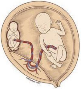 孕8个月减胎是如何操作的,多胎减胎几周前减最好