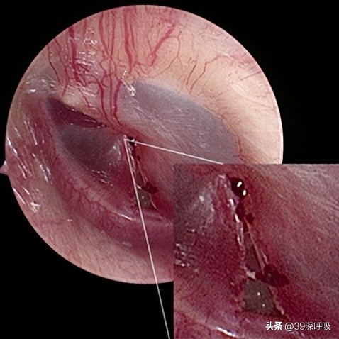 被扇嘴巴导致耳聋了,被人打了一巴掌导致神经性耳聋