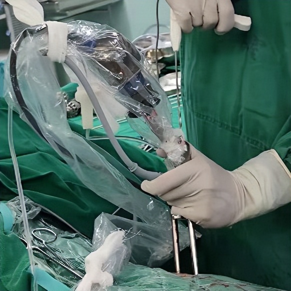 门医技术|门头沟区医院骨二科成功应用微创椎间孔镜技术治疗两例腰椎管多节段狭窄症