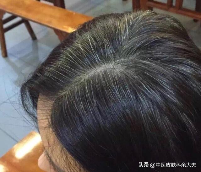 脾肾不足容易掉头发怎么调理,白头发与肝脾肾的关系