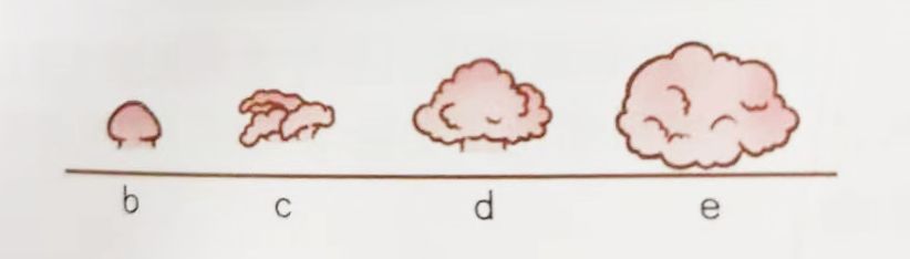 怎么确定自己是否感染尖锐湿疣,如何确认感染尖锐性湿疣