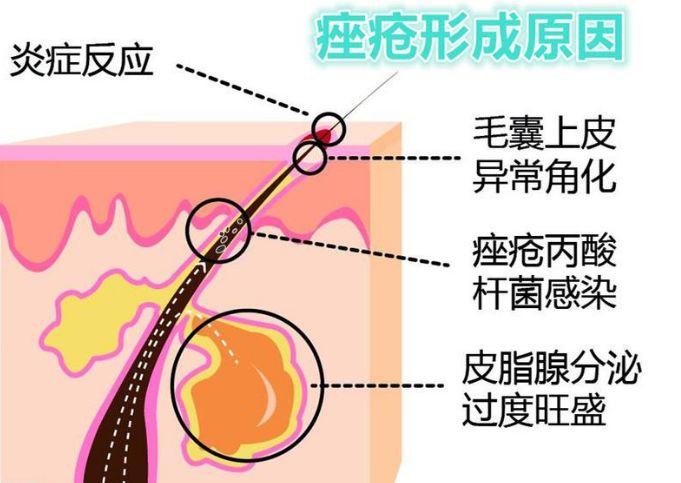 痘痘一直好不了变硬皮,痘痘一直好不了伤口溃烂