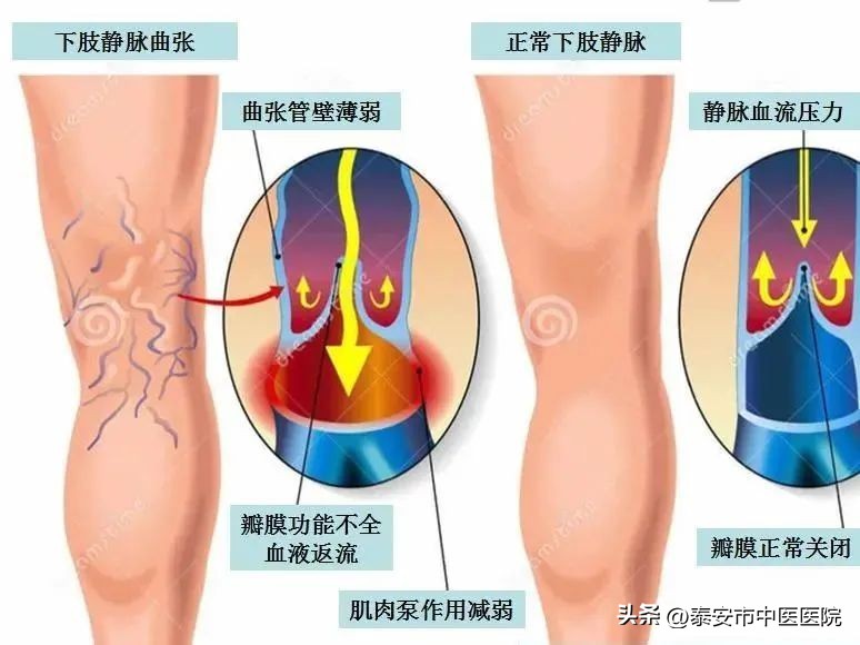 下肢静脉曲张引起的溃疡康复理疗,中医治疗下肢溃疡