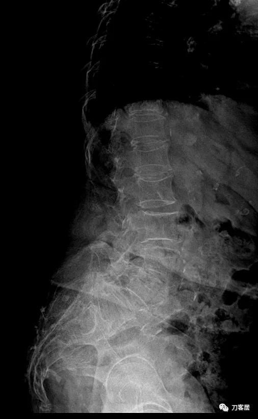 老年人腰骨裂不手术怎么治疗最好,老年腰椎骨质疏松症