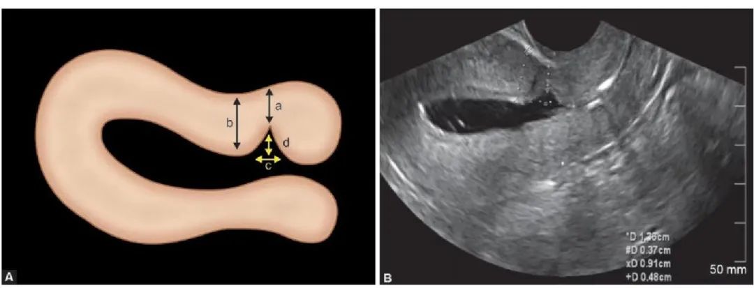 子宫憩室经期延长危害,子宫切口憩室做手术可以痊愈吗